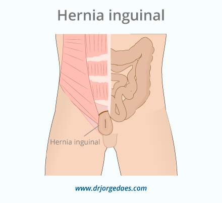 Cirugia hernia inguinal en Barranquilla Colombia