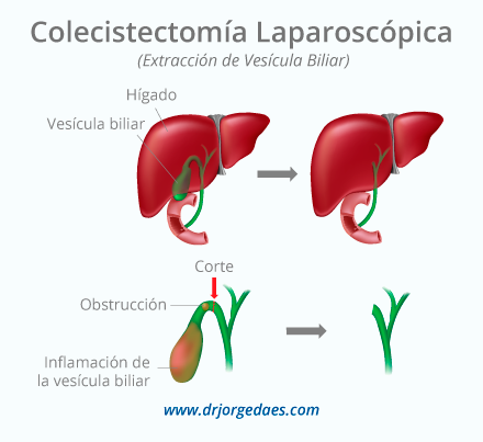 Colecistectomia Laparoscopica en Barranquilla Colombia