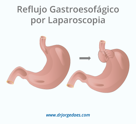 Reflujo Gastroesofagico por Laparoscopia Barranquill Colombia
