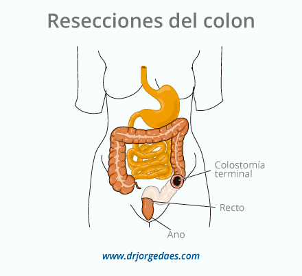 Resecciones del colon en Barranquilla Colombia